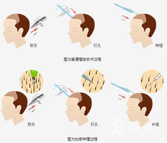 最新植发技术，重塑自信，重塑人生风采